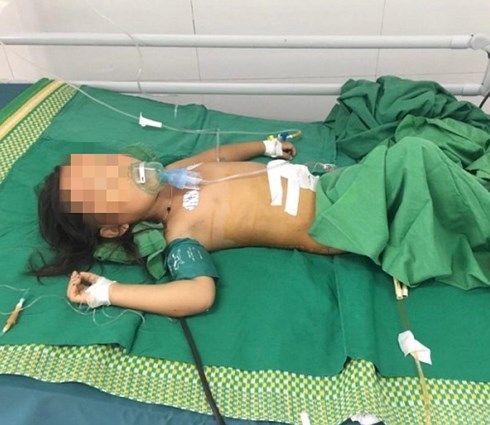 Cháu bé bị máy cắt cỏ văng vào bụng, gia đình lấy kim may “khâu sống”