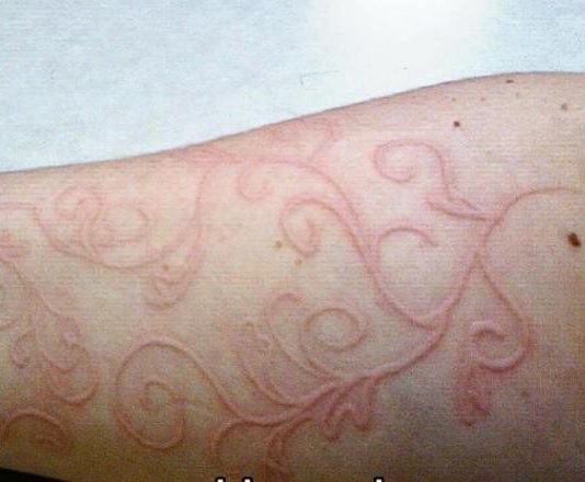 Cảnh báo chứng bệnh da vẽ nổi phát tác mùa mưa